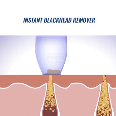 4 In 1 Multi-Function Blackhead Remover (BHR3) - Image 6