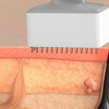 Adjustable Derma Stamp For Hair & Beard Growth Support (DR1) - Image 4