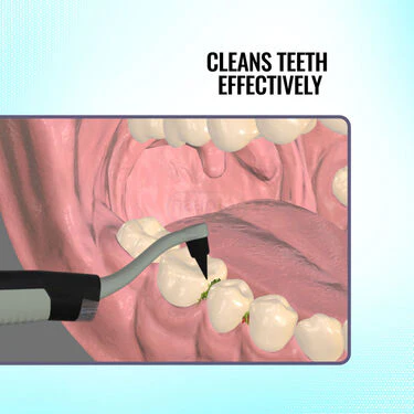 Ultrasonic Teeth Stain Remover (ETSE) - Image 5